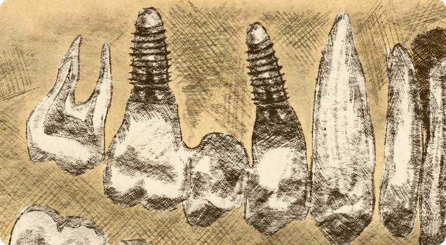 leistungen implantate fuer festsitzenden zahnersatz